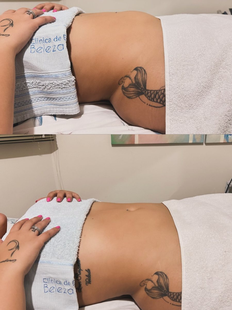 Antes e depois em clínica de estética